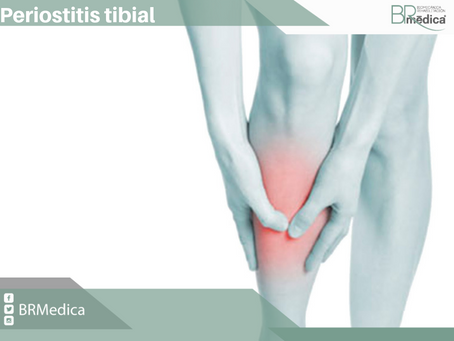Periostitis tibial