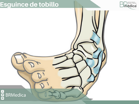 Esguince de tobillo