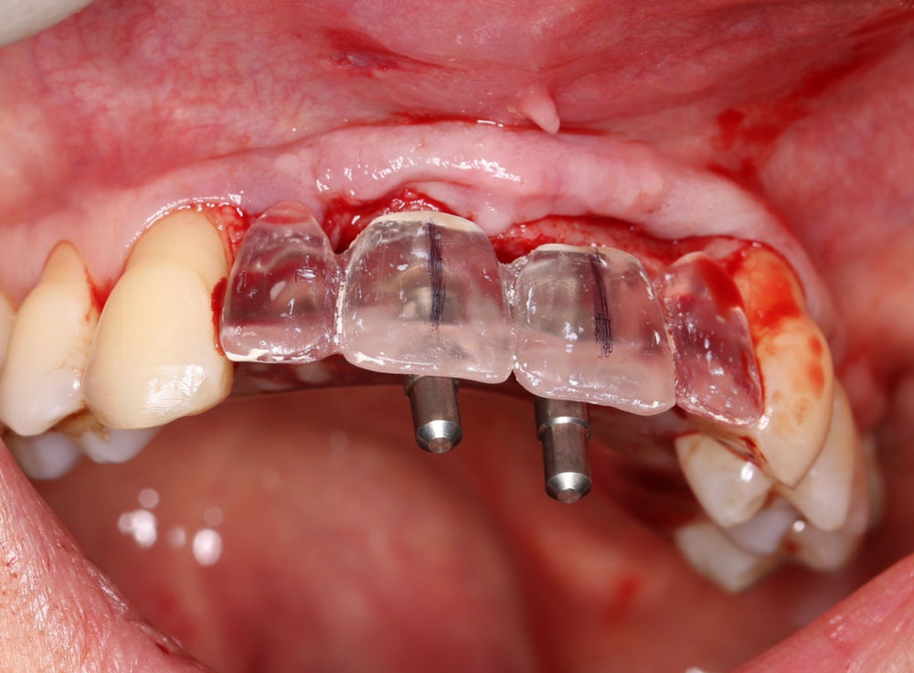 Implant bridges in the anterior