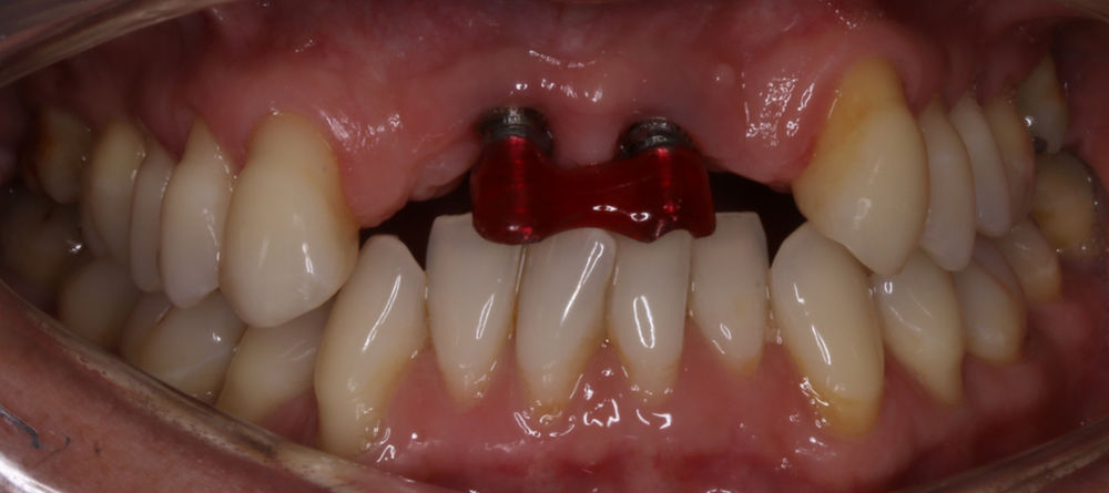 Implant bridges in the anterior