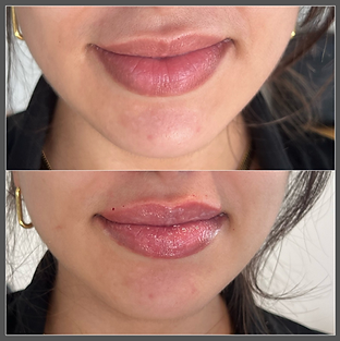 KB Aesthetics - Lip filler before and after photo 1