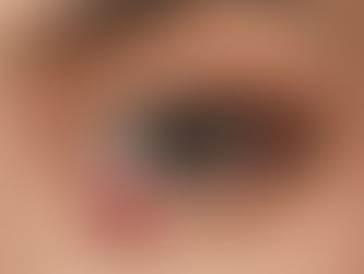 What is this Red Painful Bump on the Eyelid? Understanding and Managing Styes and Chalazions.