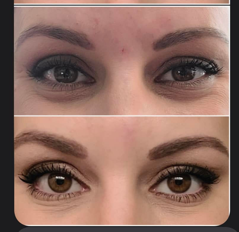 Before and After Botox Brow Lift and Eye Opening