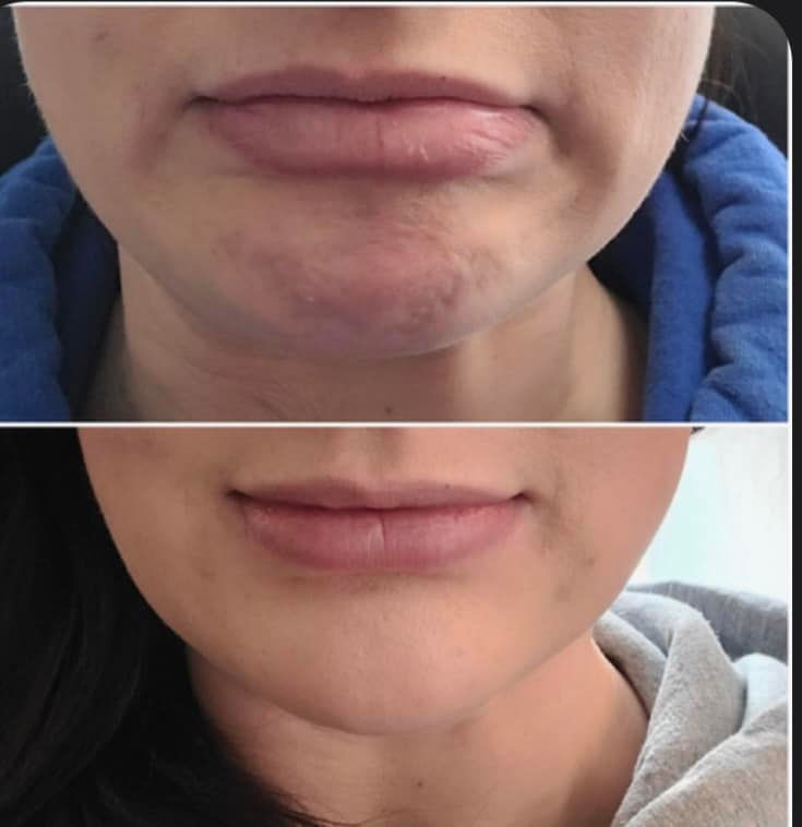 Before and after chin dimpling
