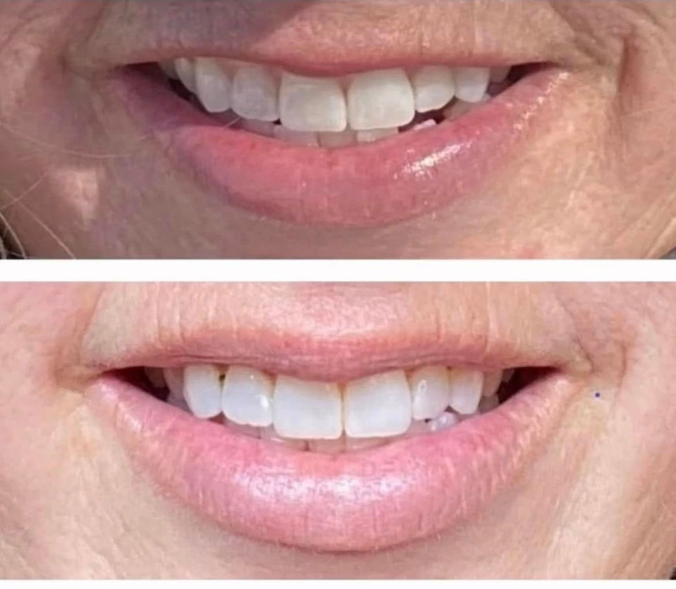 Before and After Botox Lip Flip