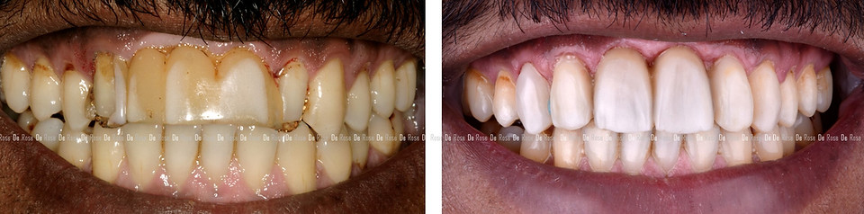 bleaching_composite_esthetics_dentist_12.jpg