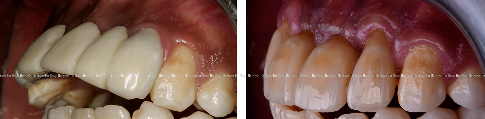 bleaching_composite_esthetics_dentist_11.jpg