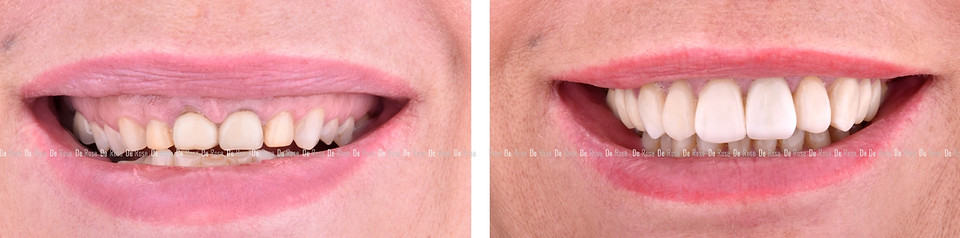 esthetique-facettes-dentaires.jpg