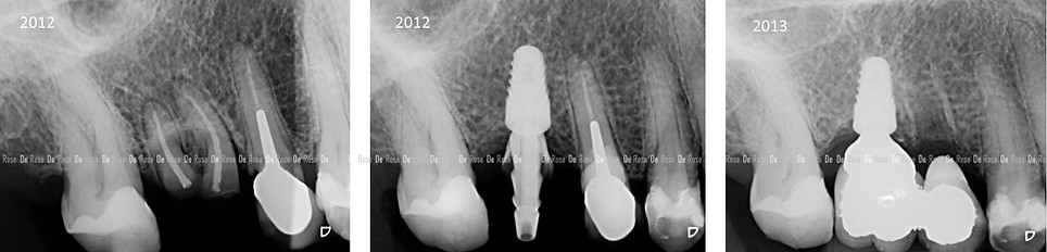 implant-dentaire