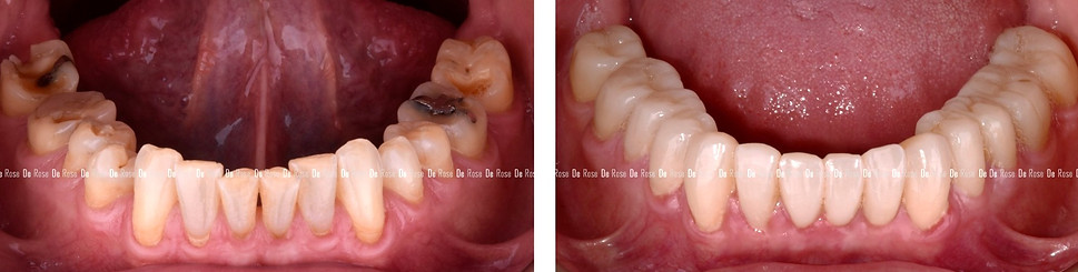 facette_blanchiment_erosion_dentaire_edi