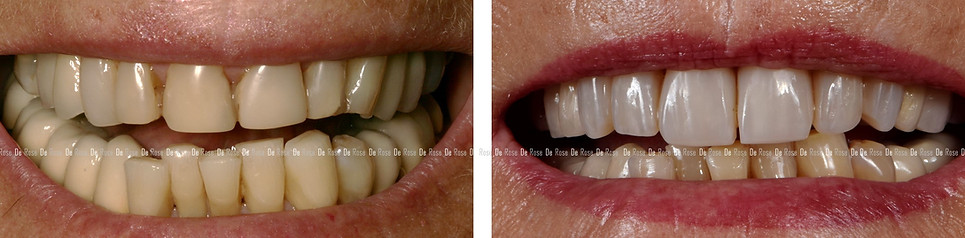 bleaching_composite_esthetics_dentist_8.jpg