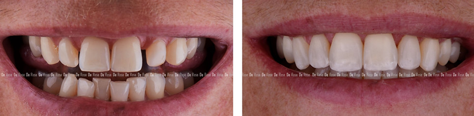 esthetique-blanchiment-facette-dentaire