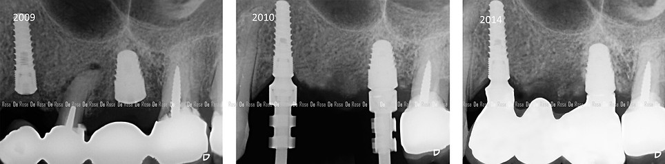 implant-dentaire