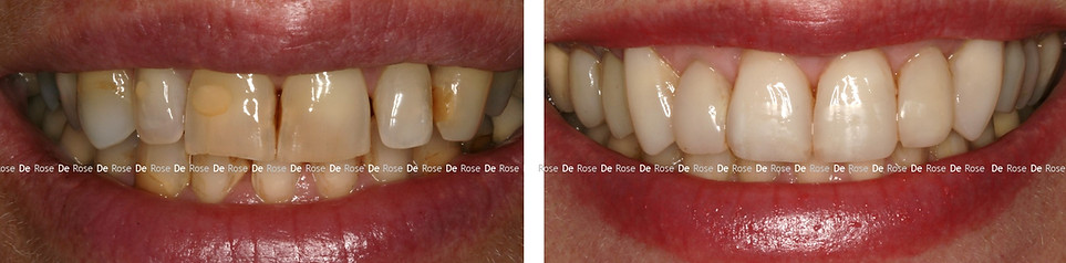 facette_blanchiment_esthetique dentaire