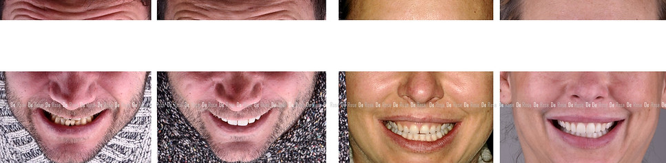 bleaching_composite_esthetics_dentist_2.jpg