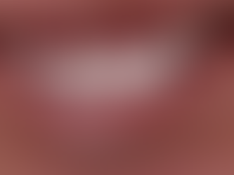 Todo sobre el tratamiento quirúrgico para encías en Puebla