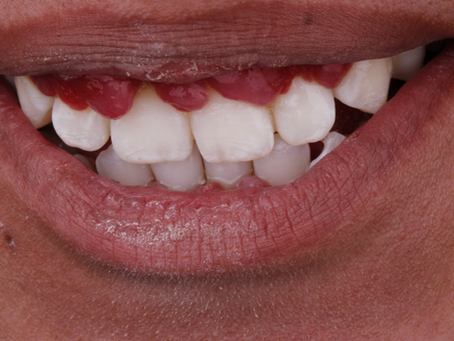 Todo sobre el tratamiento quirúrgico para encías en Puebla