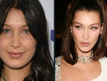 Botox vs Fillers - Everything you need to know