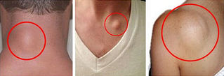 How To Get Rid Of Skin Lumps (Lipomas) Naturally!
