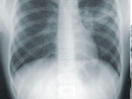 Doctors perform first double lung transplant, 195 arrested in human trafficking sweep
