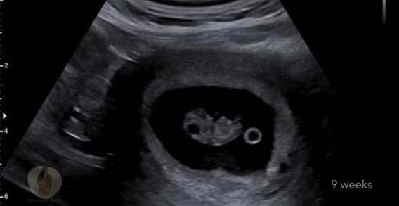 first trimester baby ultrasounds, Vero Beach Florida, Fort Pierce, FL, Port st Lucie florida