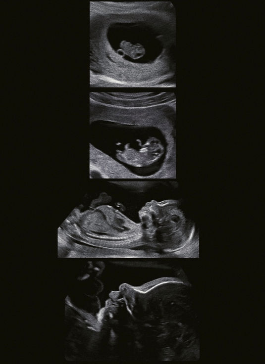 Pregnancy ultrasound near me in Port St. Lucie