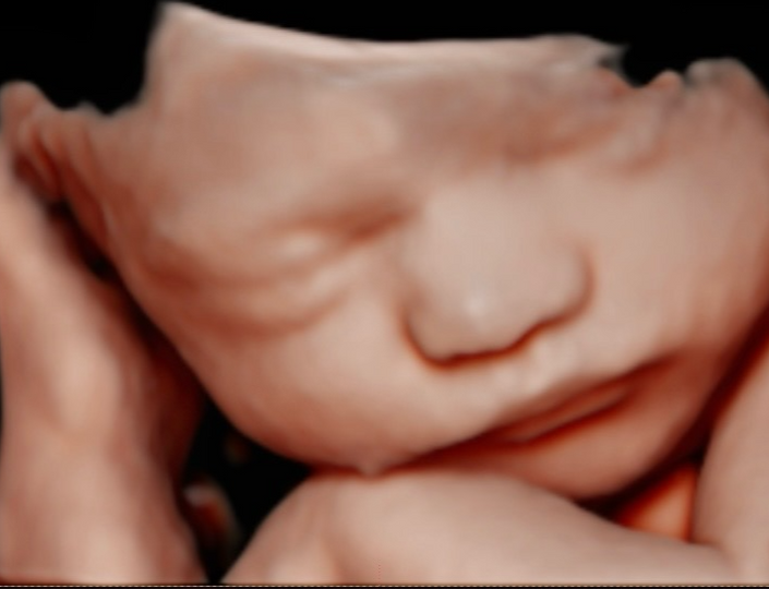 3d ultrasounds