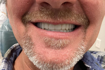 Happy patient showing a natural-looking smile after receiving digitally crafted dentures.