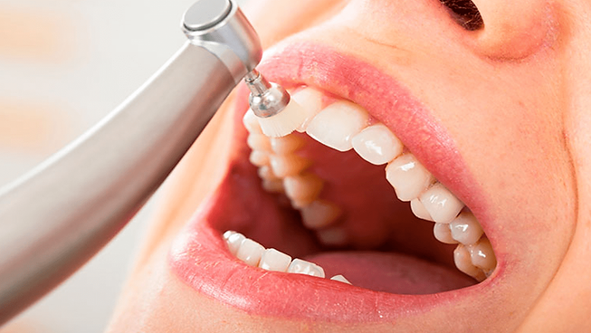 limpieza-dental-profesional.png