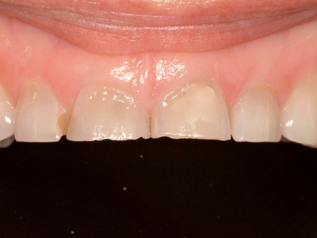 Could some medications cause teeth grinding?