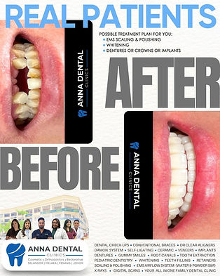 dental implants Selangor Johor Penang.jpg