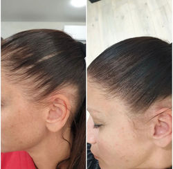 Scalp micro pigmentation hairline Bellevue WA
