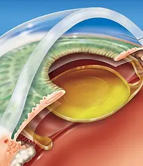 cirurgia-de-catarata.webp