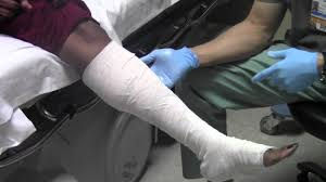 Médico aplicando gesso em perna