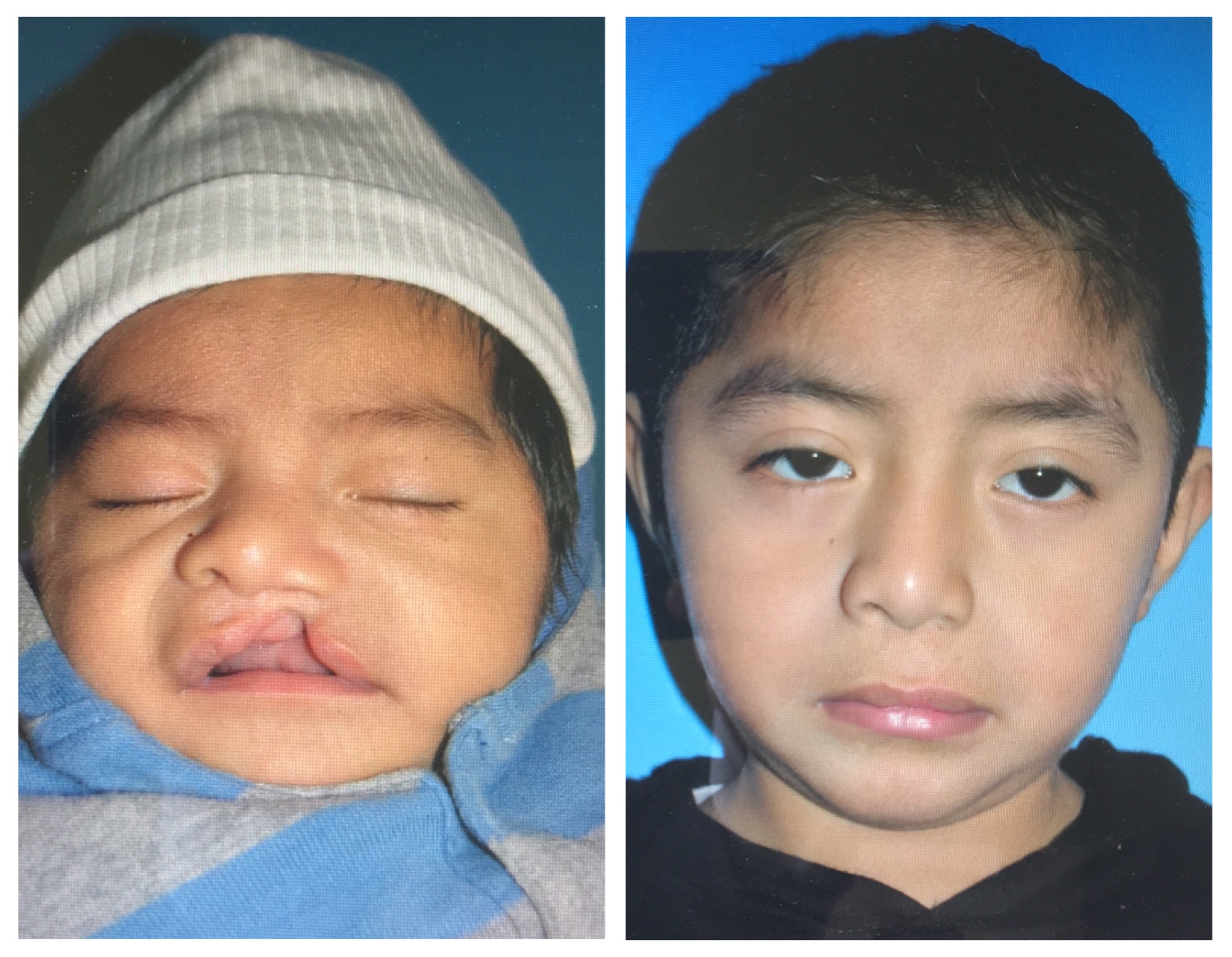 Cleft Lip and Palate