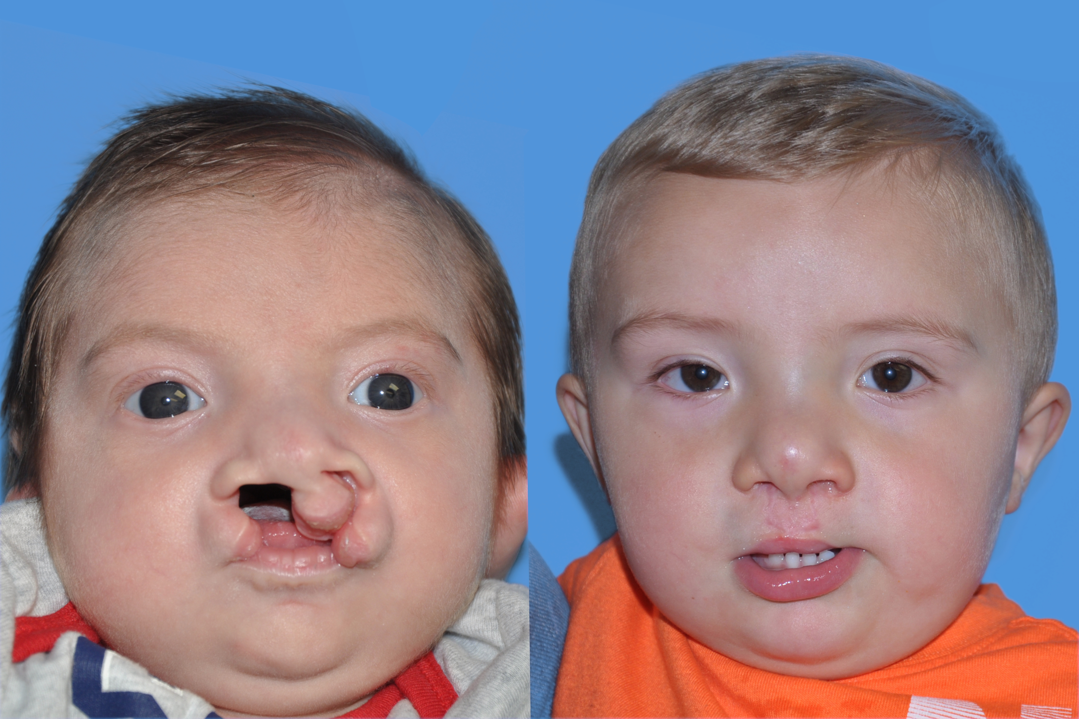 Cleft Lip and Palate