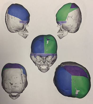Pfeiffer Syndrome Surgical Planning
