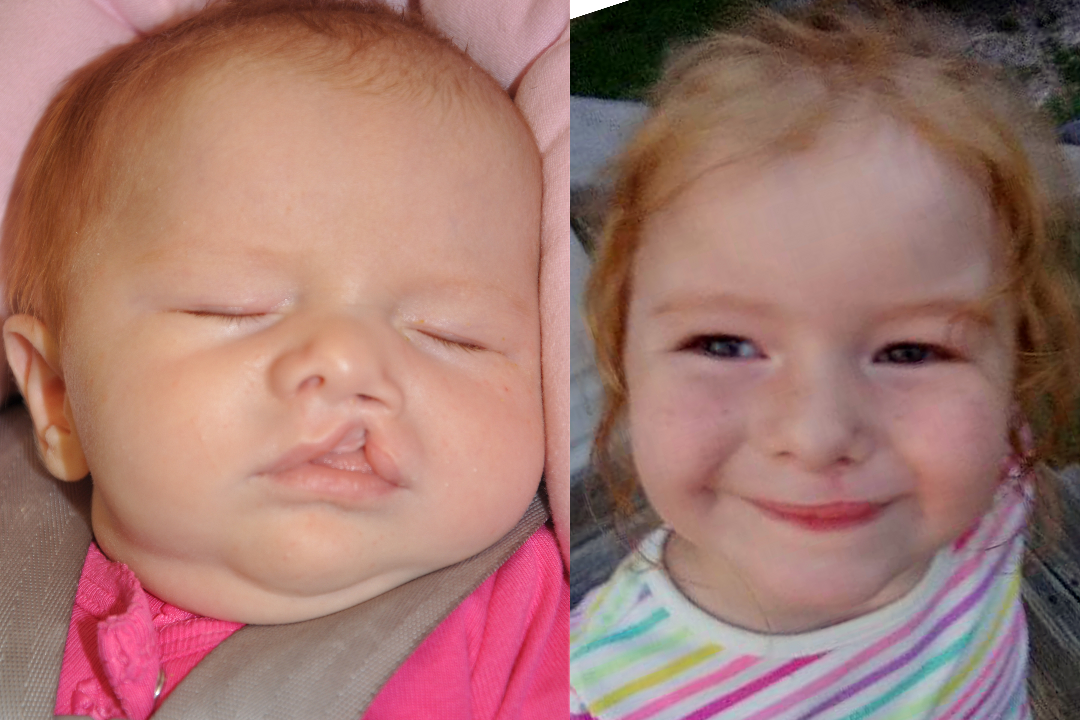 Cleft Lip and Palate