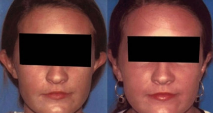 Otoplasty