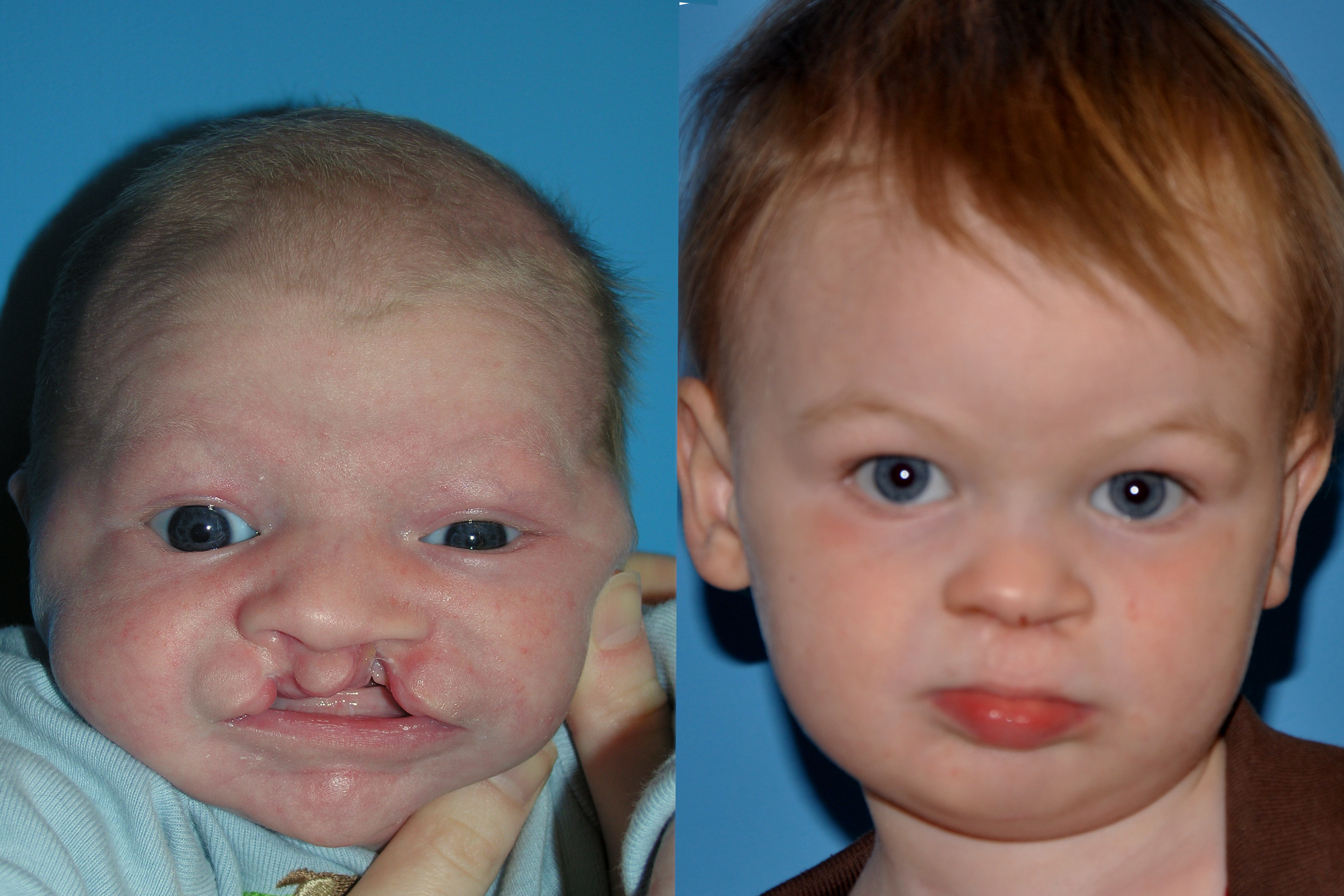 Cleft Lip and Palate
