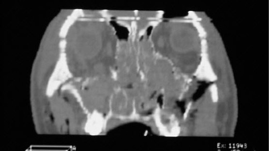 Maxillary Fractures