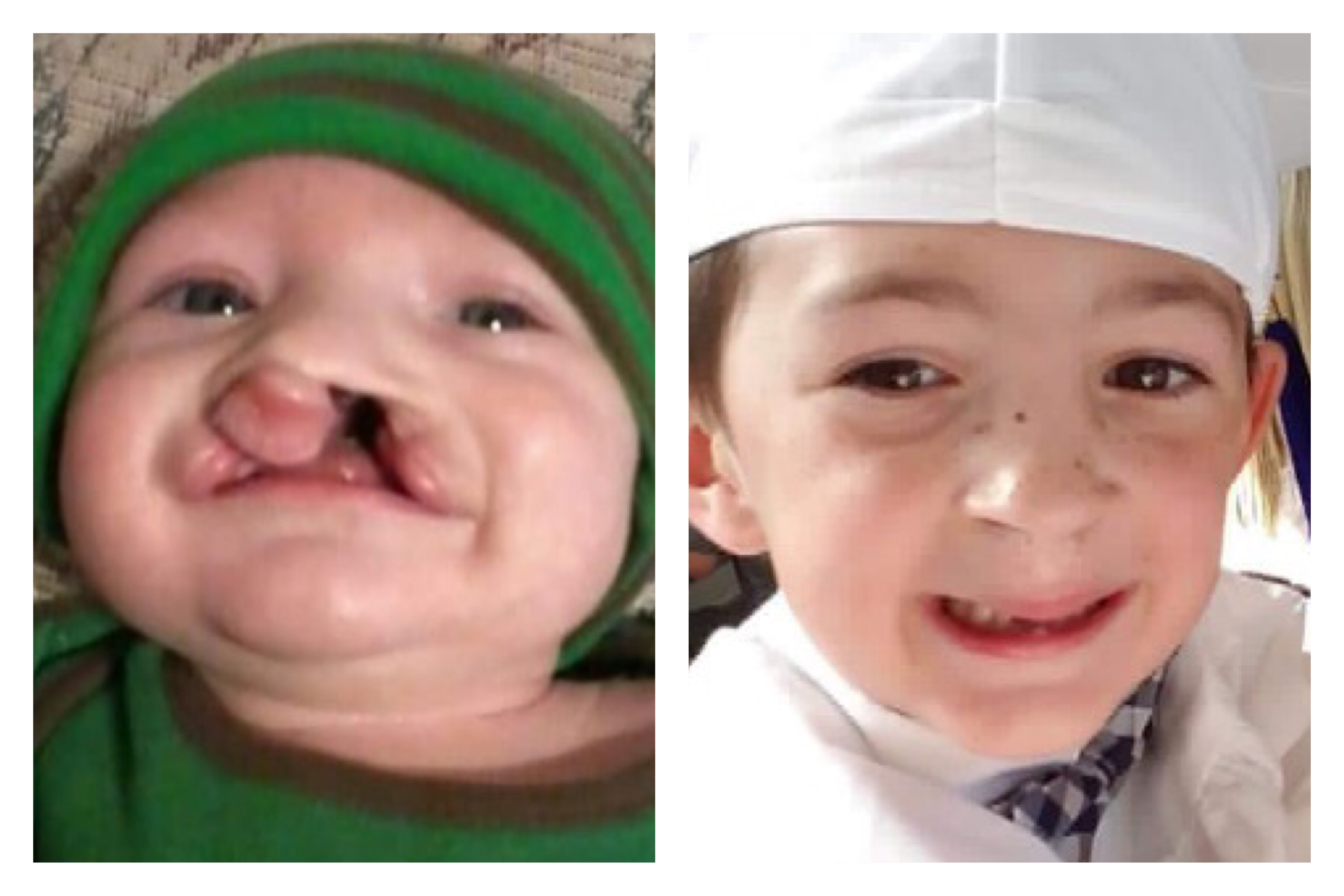 Cleft Lip and Palate