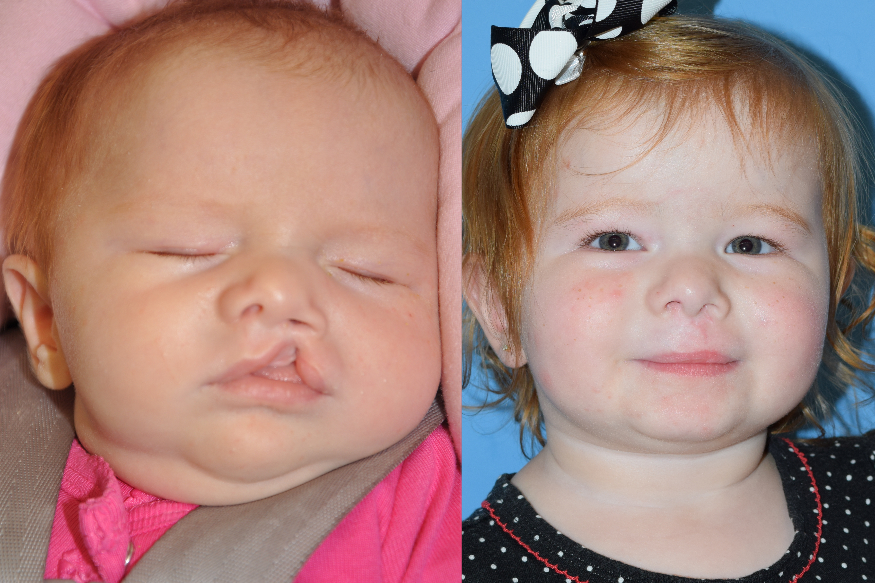 Cleft Lip and Palate