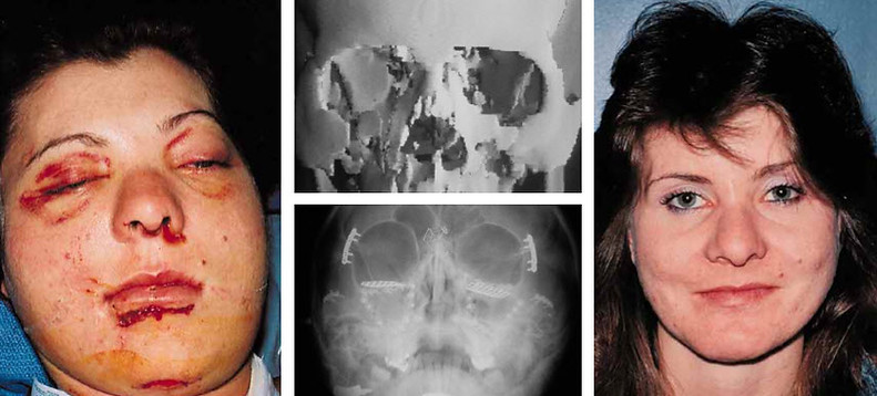 Maxillary Fractures