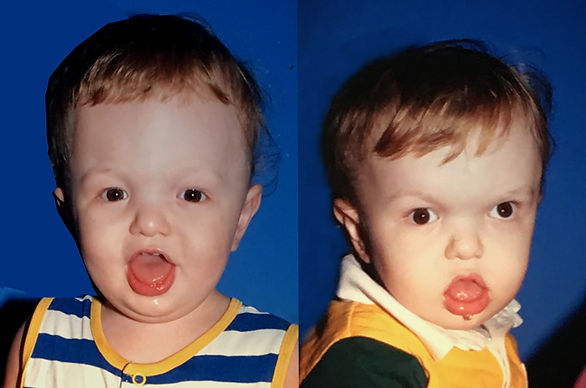 Pfeiffer Syndrome Pre and Post Operative