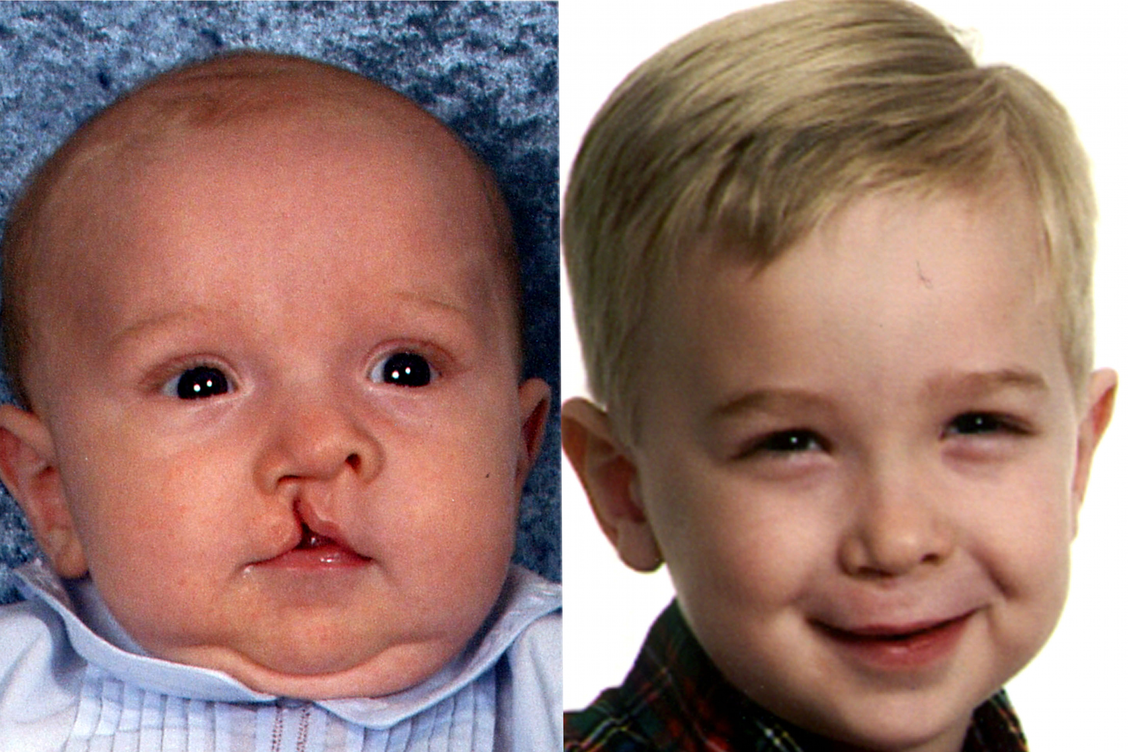 Cleft Lip and Palate