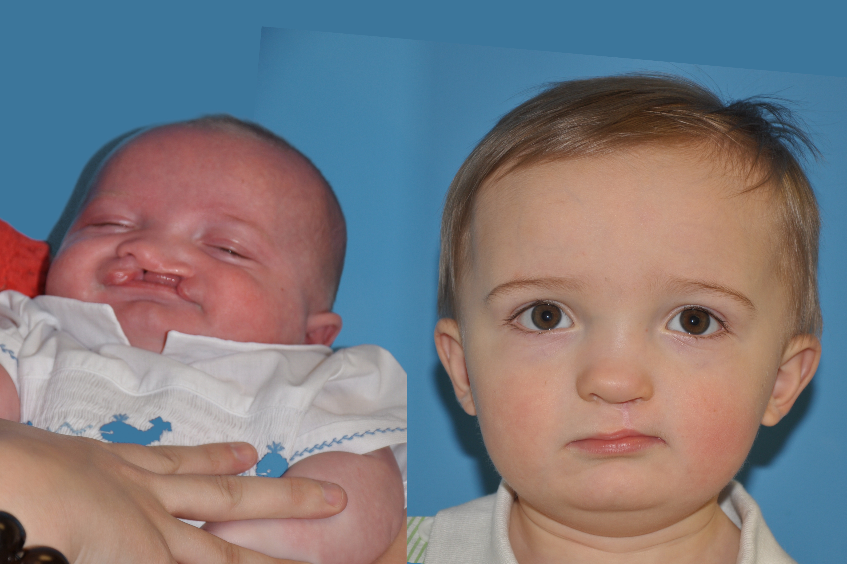 Cleft Lip and Palate
