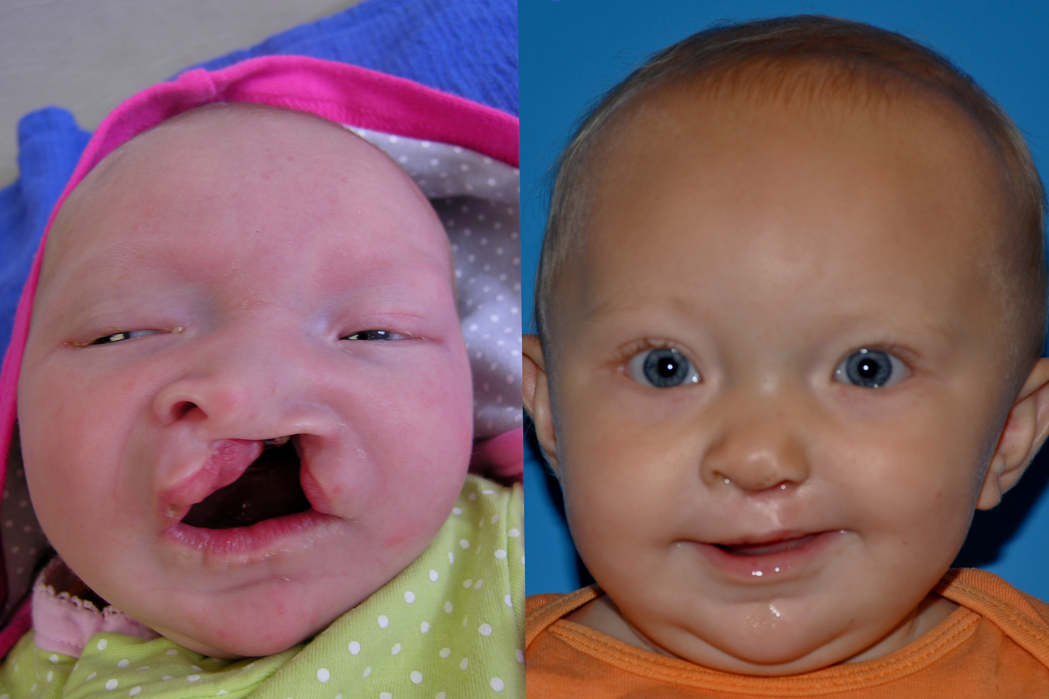 Cleft Lip and Palate