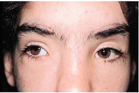 Canthal Surgery