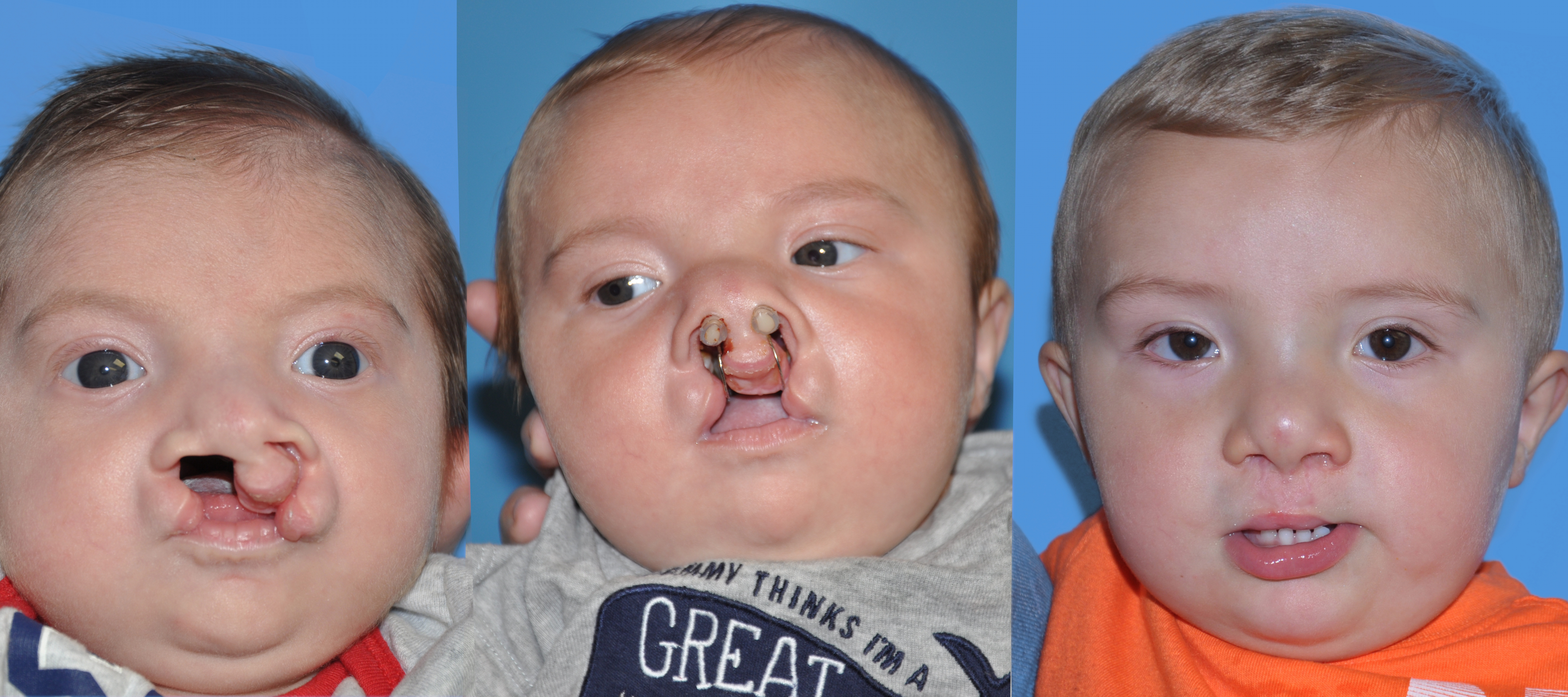 Cleft Lip and Palate